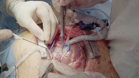 Medical staff of the operating unit do heart surgery. Shunt installation Video stock 104923208