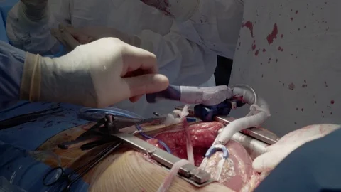 Medical staff of the operating unit do heart surgery. The nurse assists in Vídeo Stock 104923443