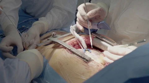Medical staff of the operating unit do heart surgery. The nurse assists in Stock Footage 104923629