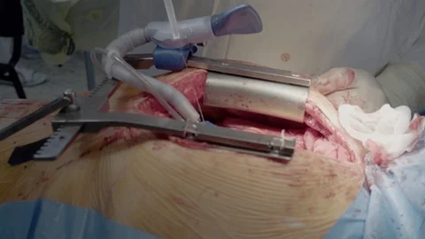 Medical staff of the operating unit do heart surgery. Preparing to install a Stock Footage 104923659