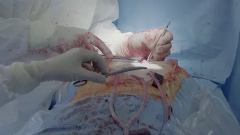 Medical staff of the operating unit do heart surgery. The nurse assists in Video stock 104924170