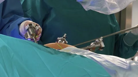 MEDICAL SURGICAL USING DEVICES DURING THE OPERATION Stock Footage 201741630