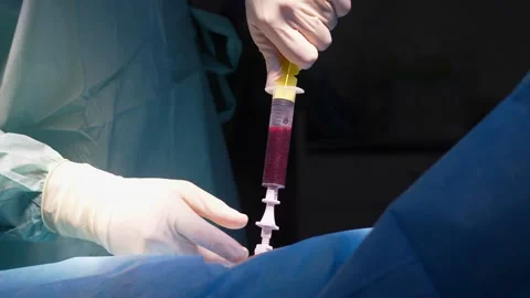 Medical team in an operating room performing a bone marrow biopsy, aspirating Stock Footage 345682115