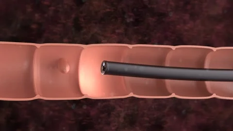 Medical technology with 3d rendering endoscope and colonic polyp in intestine Stock-Footage 314692341