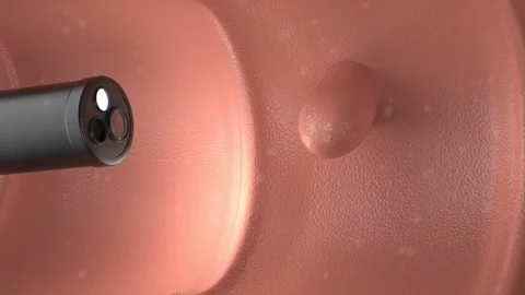Medical technology with 3d rendering endoscope and colonic polyp in intestine Stock Footage 314692344