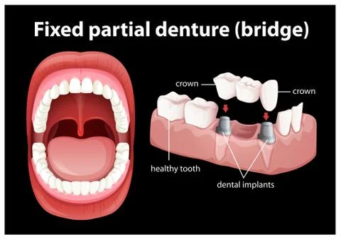 Medical Vector of Fixed Partial Denture Illustrazione stock