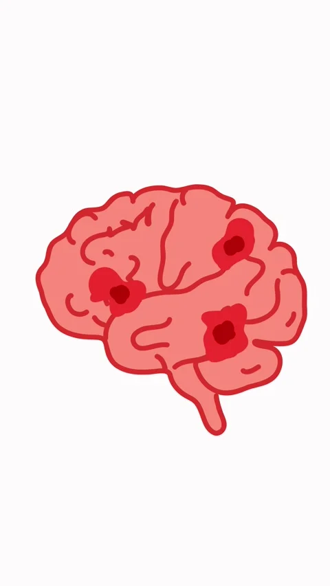 Medical visualization of brain damage with neuronal structure impairment Stock Footage 336175527