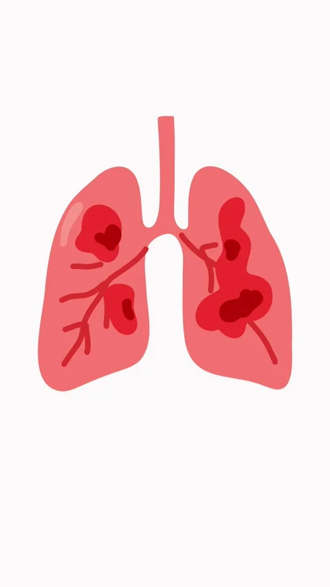Medical visualization of lung damage with tissue inflammation Stock Footage 336175539