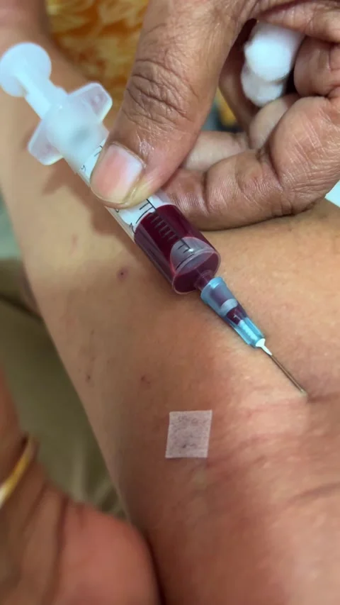 Medical Worker Drawing Blood Sample From Patient Arm Vein With Syringe Close 스톡 동영상 336269639