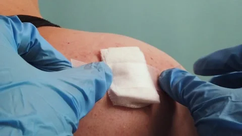 Medical worker secures gauze dressing on treated shoulder skin. Stock Footage 345544088