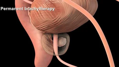 Medically accurate 3d illustration of prostate cancer Stock Illustration