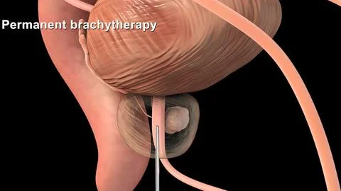 Medically accurate 3d illustration of prostate cancer Stock Illustration