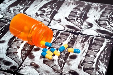 Medication on an xray Stock Photos