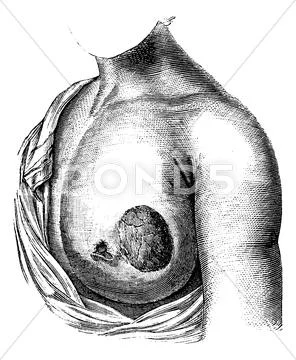 Enlarged breasts, vintage engraving. - Stock Illustration