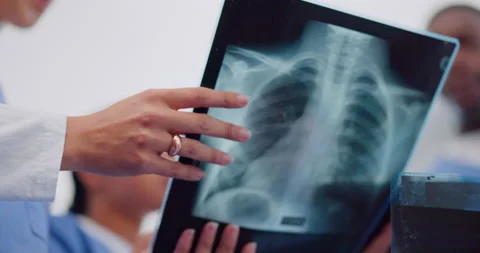Meeting, discussion and doctors analyzing xrays of lungs after a health Stock Footage 229104122