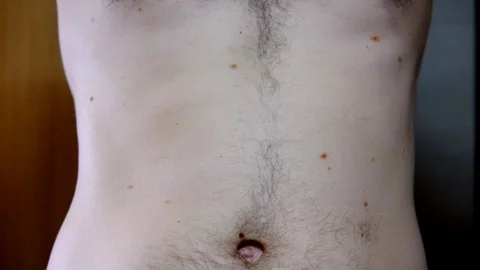 Melanocytic nevus, some of them dyplastic or atypical, on a caucasian man of 36 Stock Footage 107946412