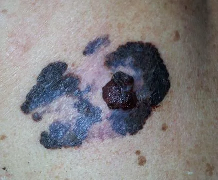 Melanoma Foto stock