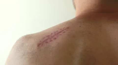 Melanoma scar Video stock 49103487