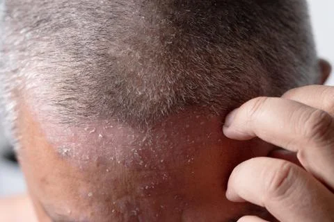 Men are using his hands to scratch the head ulcers Foto stock