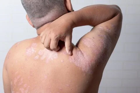 Men are using his hands to scratch the shoulder ulcers Stock Photos