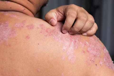 Men are using his hands to scratch the shoulder ulcers Foto stock