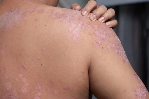 Men are using his hands to scratch the shoulder ulcers Foto stock