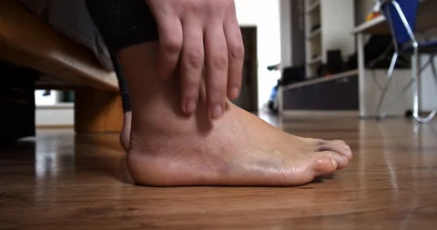 Men leg after a sprained ligament injury close up walk Stock Footage 104835935