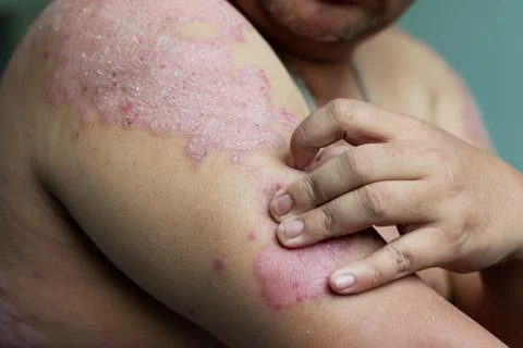 Men use their hands to scratch the wound in their arms Stock Photos