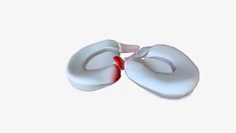 Meniscal root tears are less common than meniscal body tears and frequently go Stock Footage 246052839
