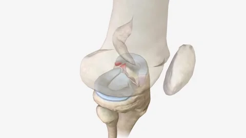 Meniscal root tears are less common than meniscal body tears and frequently go Stock Footage 246055013