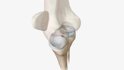 Meniscal root tears are less common than meniscal body tears and frequently go Stock Footage 246055018