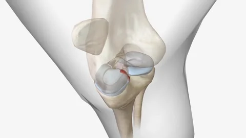 Meniscal root tears are less common than meniscal body tears and frequently go Stock Footage 246055205