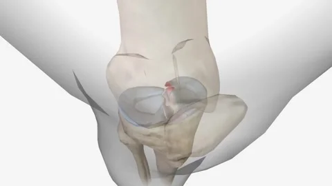 Meniscal root tears are less common than meniscal body tears and frequently go Stock Footage 246055435
