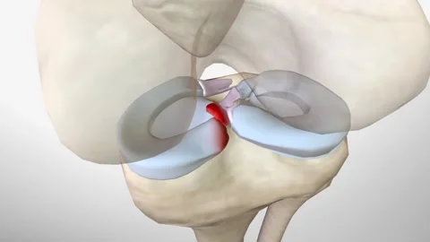 Meniscal Root Tears Are Less Common Than Stock Video Pond