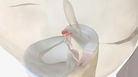 Meniscal root tears are less common than meniscal body tears and frequently go Stock Footage 246056322