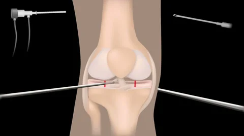 Meniscus repair Vídeos de archivo 30191946