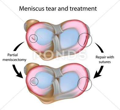 Meniscus tear and surgery Stock Illustration