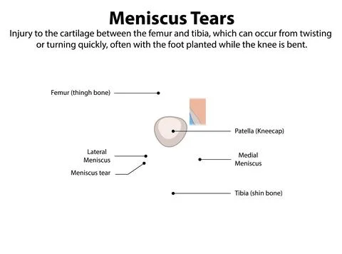 Meniscus Tears in the Knee Stock Illustration