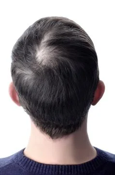 Men's hair with a bald patch before using cosmetic powder to thicken hair. Wh Stock Photos
