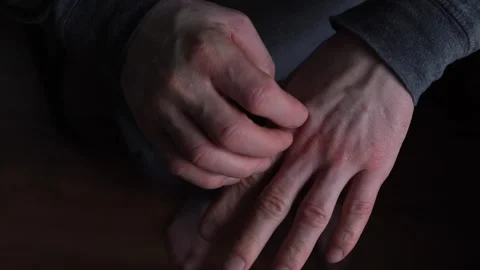 Men's hands scratch one another, a disease of the skin of the hands. Scabies Stock Footage 273685617