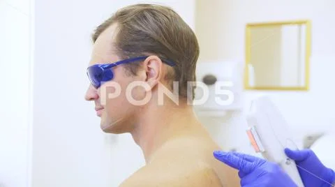 Men's laser hair removal. the doctor in blue gloves removes hair from the Stock Photos