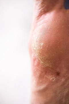 Men's leg close-up with the problem of dry skin Stock Photos