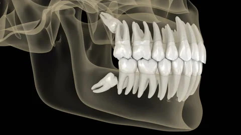 Mesial impaction of Wisdom teeth to the second molar Stock Footage 205079007