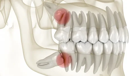 Mesial impaction of Wisdom teeth to the ... | Stock Video | Pond5