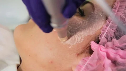 Meso glow bb procedure. Subcutaneous injection of serum for skin lightening. The Stock Footage 83620525