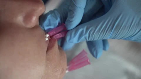 Mesotherapy with the introduction of PDO mesothreads. Close up video. Stock Footage 289189005