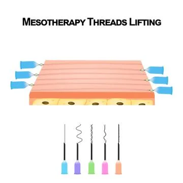 Mesotherapy Threads Lifting. Different types of threads for facelift. The Illustrazione stock
