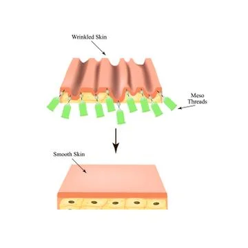 Mesotherapy Threads Lifting. threads for facelift. The structure of the skin Stock Illustration