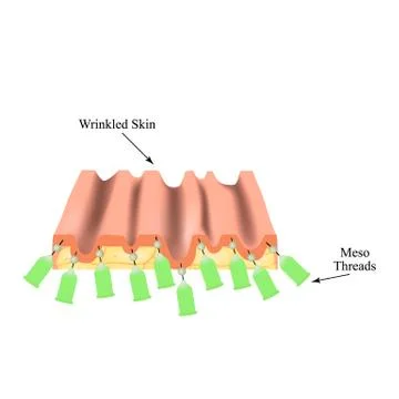 Mesotherapy Threads Lifting. threads for facelift. The structure of the skin Stock Illustration