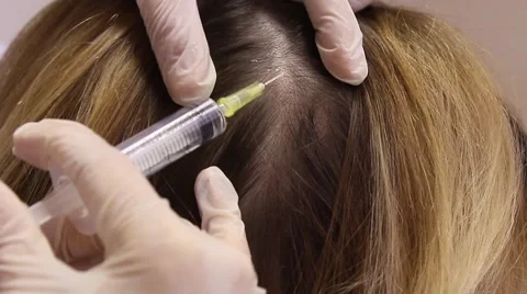 Mesotherapy treatment, alopecia with syringe Stock Footage